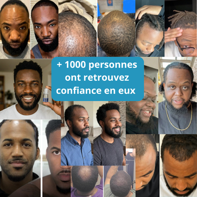 Micro Infusion sur Homme Noir  - Derma Afro